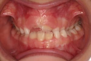 Unilateral crossbite