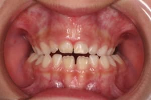 Bilateral crossbite