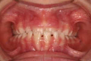 Anterior crossbite