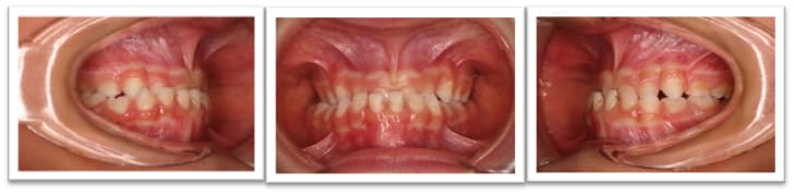 Anterior and lateral crossbite